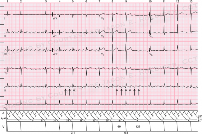 Wenckebach Ecg